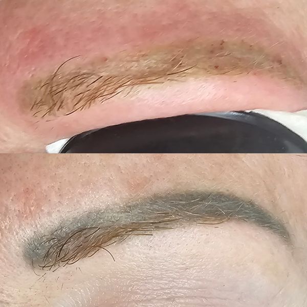 COSMETIC TATTOO REMOVAL Infinity Cosmetic Tattoo